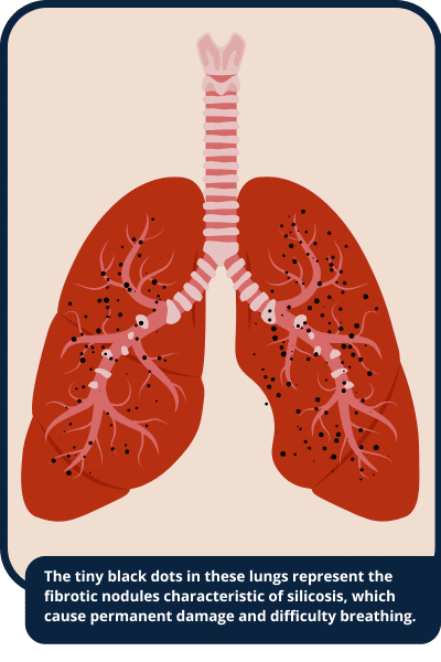 Diagram of lungs with silicosis